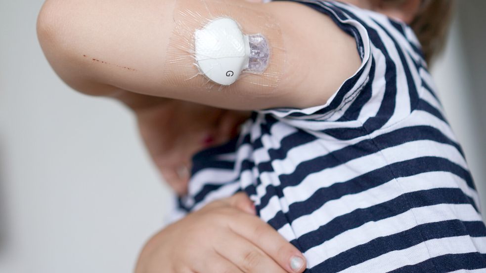 Ein Sensor am Oberarm misst den Blutzuckerwert des Patienten. Foto: dpa/Carstensen