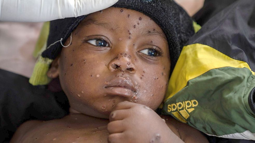 Ein an Mpox erkrankter zweijähriger Junge liegt in einem Krankenhaus in Kamituga im Osten des Kongo. Foto: Moses Sawasawa/AP